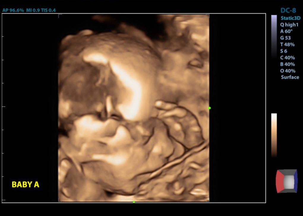 20 week ultrasound twins 3-d