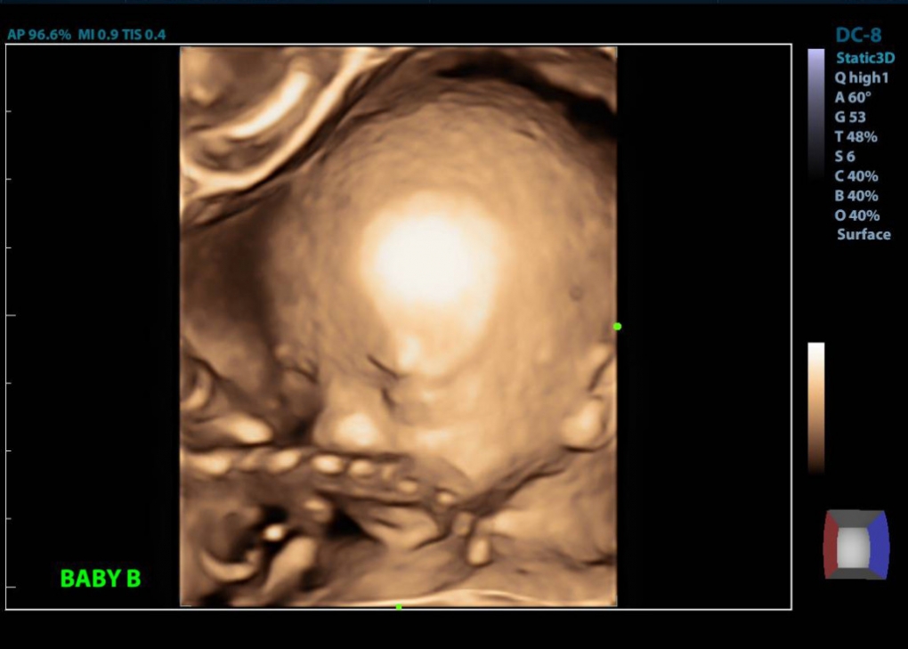 20 week ultrasound twins 3-d